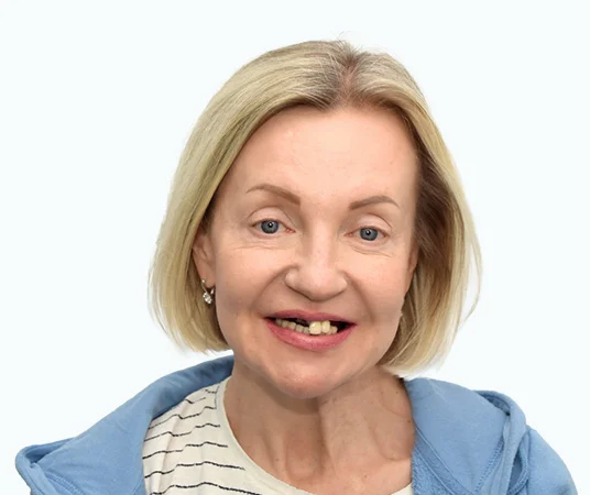 До имплантации зубов