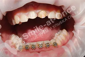Зубные протезы на передние зубы