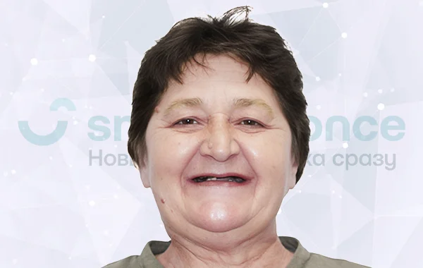 Имплантация всех зубов all-on-6 Nobel Biocare до