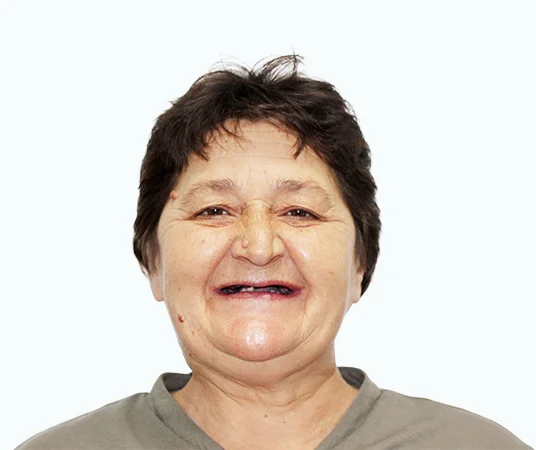 Фото: ДО имплантации