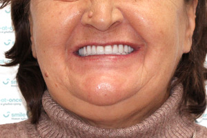 Восстановление всех зубов All-on-6 ПОСЛЕ