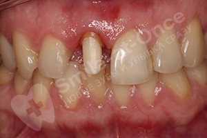 Коронка из диоксида циркония на передний зуб