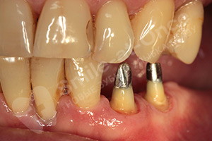 Диоксид циркония на жевательные зубы