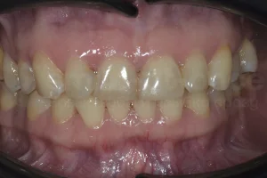 Восстановление эстетики и защита зубов винирами ДО