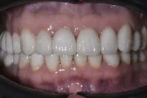 Восстановление эстетики и защита зубов винирами ПОСЛЕ