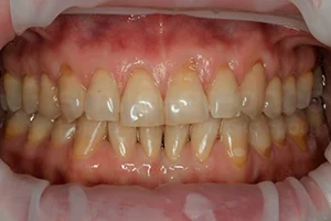 Тотальная реабилитация всех зубов винирами ДО