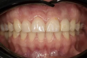 Комплексная реабилитация всех зубов ДО