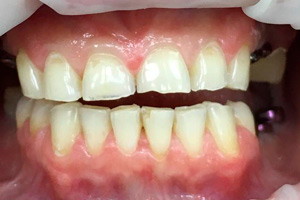 Виниры из керамокомпозита на передние зубы и имплантация для восстановления жевательных зубов, фото до