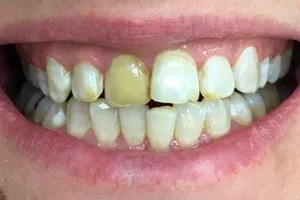 Установка виниров и коронок из керамики на зубы верхней челюсти, фото до