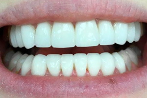 Виниры на фронтальную зону зубов верхней и нижней челюсти, фото после