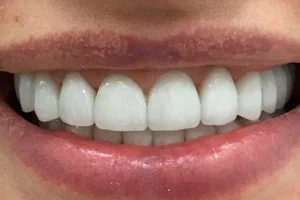 Виниры из керамокомпозита на передние зубы и имплантация для восстановления жевательных зубов, фото после