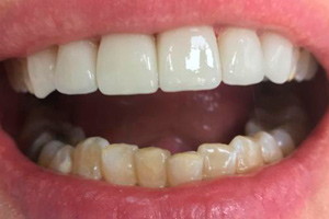 Установка виниров и коронок из керамики на зубы верхней челюсти, фото после