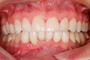 Виниры для улучшения эстетики зубов, фото после