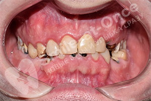 Имплантация и протезирование зубов All-on-6
