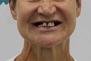 Комплексная базальная имплантация верх. челюсти