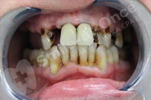 Восстановление зубов верхней челюсти