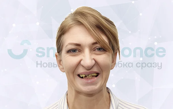 Имплантация всех зубов all-on-4 Nobel Biocare до