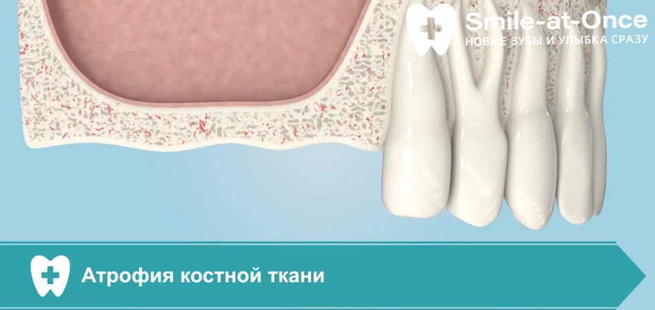 Видео: закрытый синус лифтинг
