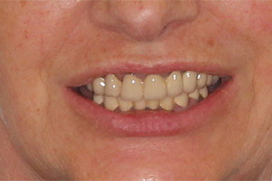 Комплексная однофазная имплантация зубов
