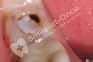 Лечение зуба и замена пломбы - До