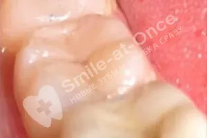 Лечение зуба и замена пломбы - После