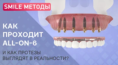 Как проходит имплантация зубов all-on-6