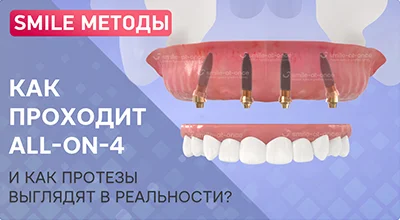 Как проходит имплантация зубов all-on-4