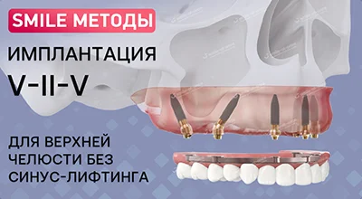Имплантация всех зубов V-II-V
