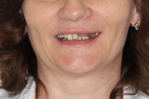 Постоянное протезирование зубов по протоколам All-on-6 и All-on-4