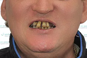Скуловая имплантация зубов ДО