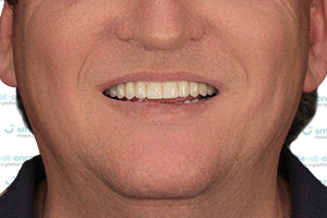 Скуловая имплантация зубов ПОСЛЕ