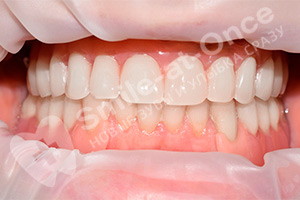 Восстановление зубов при помощи имплантации и протезирования