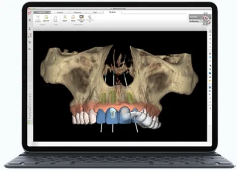 применяем цифровые решения для имплантации зубов