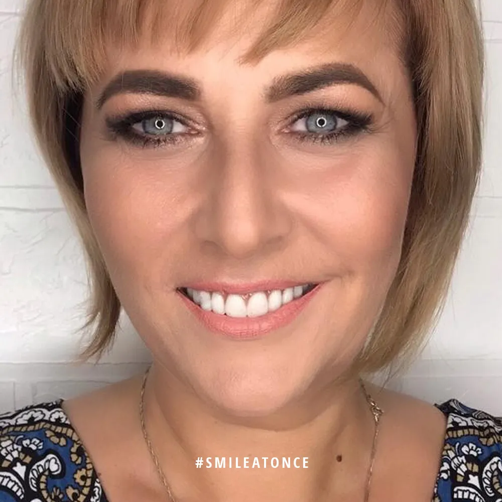 Ольга Пыхова с новой улыбкой после имплантации