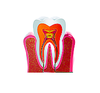 Установка пломбы на зуб
