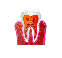 Установка пломбы на зуб