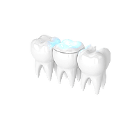 Восстановительные вкладки на зубы