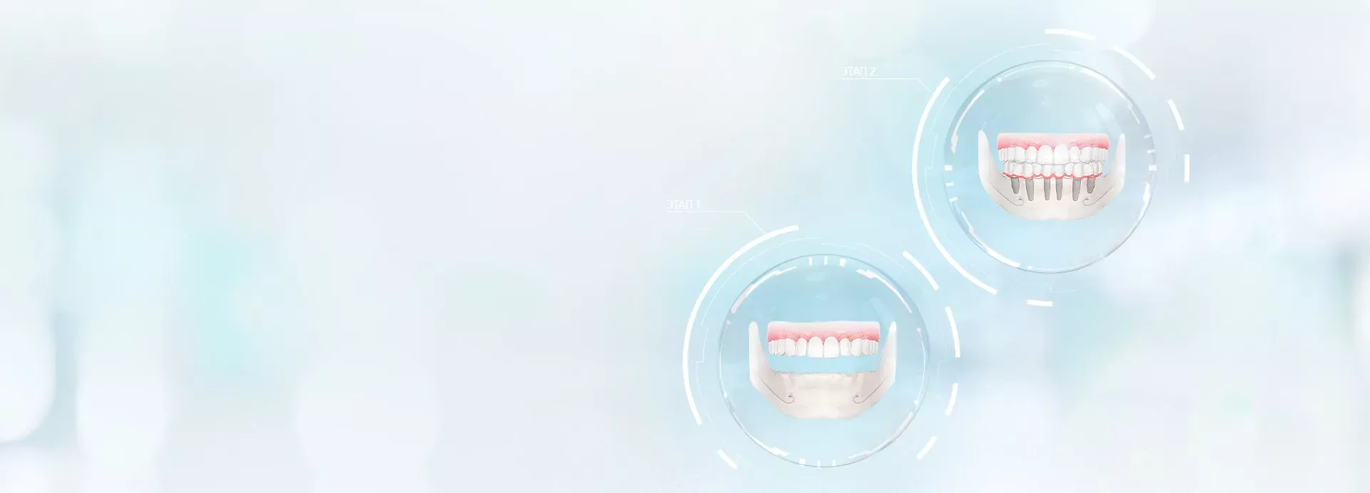 Проведение имплантации зубов с помощью Hi-tech